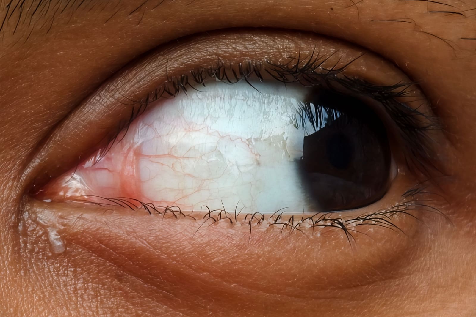 Foreign Bodies in the Eye — What to Remove, What to Leave Alone, and When to Run